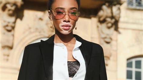 porn stars with vitiligo|Outshining Vitiligo – 31 Famous Models with Vitiligo.